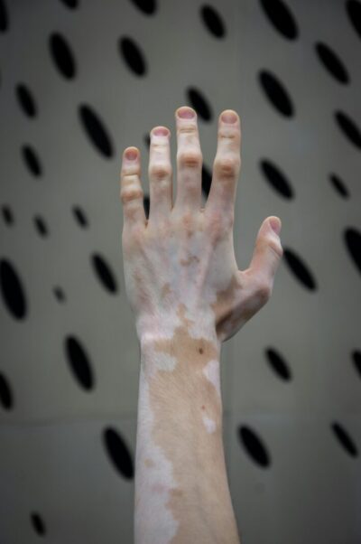 pexels vika glitter 392079 17958802 Petele pigmentare - cauze, tratamente, prevenție