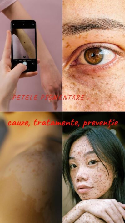 petele pigmentare